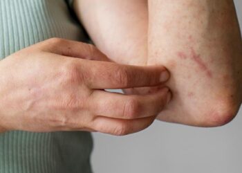 Reporta Salud 44 nuevas hospitalizaciones por dengue