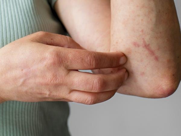 Reporta Salud 44 nuevas hospitalizaciones por dengue